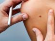 Бережіться! Чим відрізняється меланома від інших раків шкіри та як її розпізнати