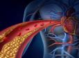 Атеросклероз не завжди болить: ТОП-5 тихих сигналів, які ігнорувати небезпечно