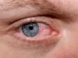 Не ігноруйте! Чому людина може відчувати пісок та печіння в очах